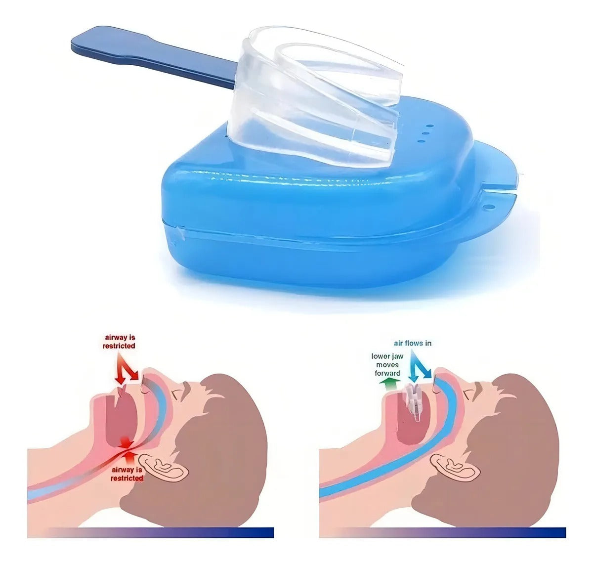 PLACA DORMAX® - ANTI BRUXISMO Y RONQUIDO